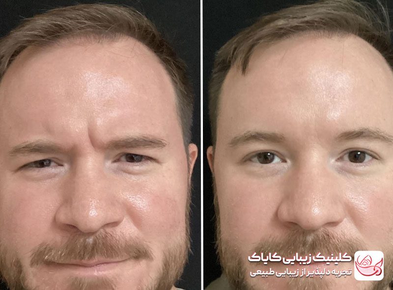 تزریق بوتاکس پیشانی