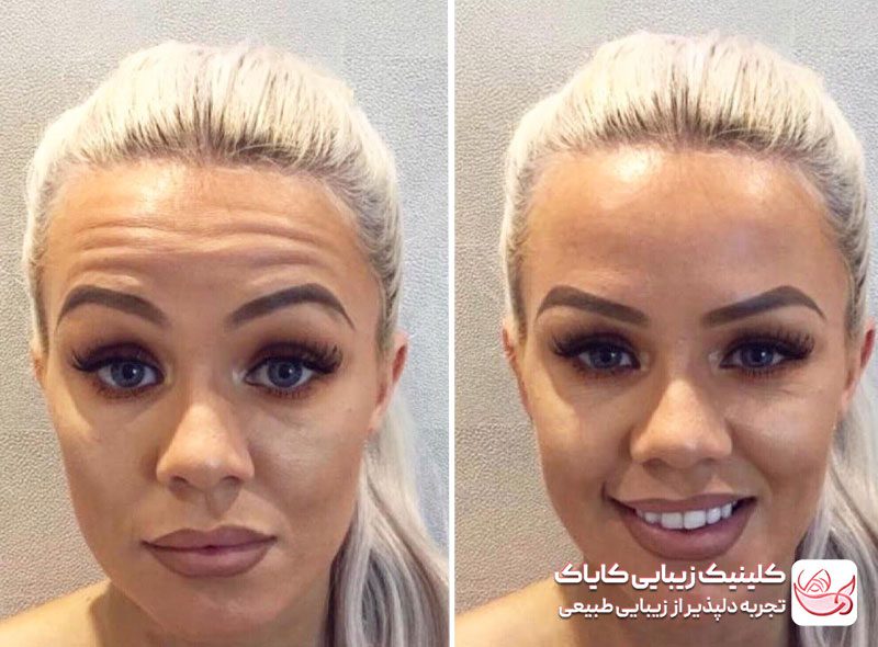 تزریق بوتاکس پیشانی