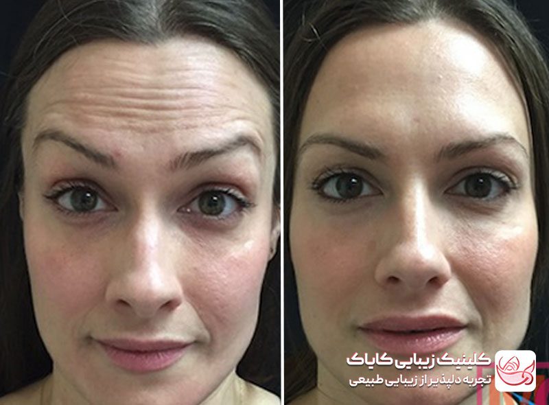 تزریق بوتاکس پیشانی