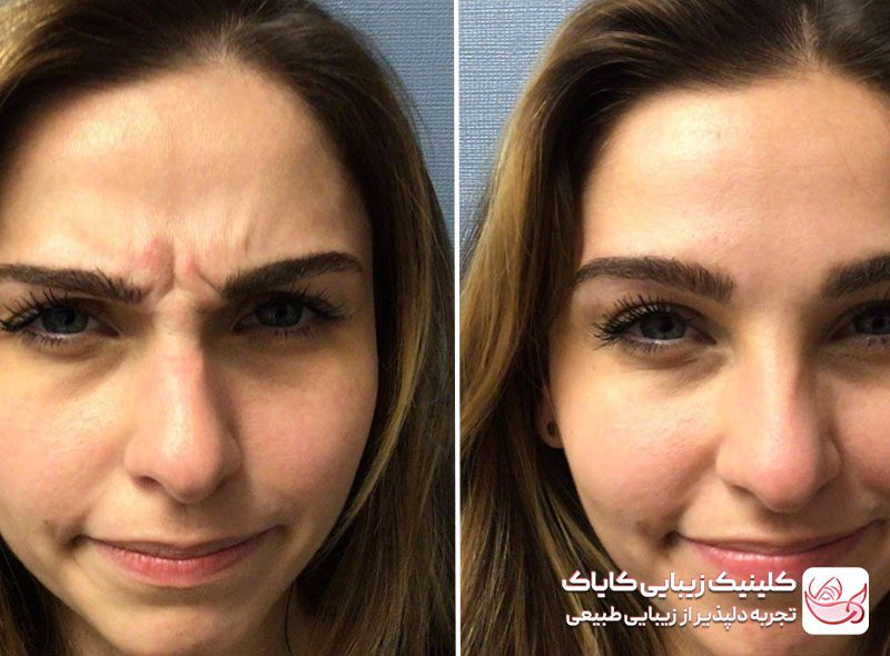 تزریق بوتاکس پیشانی برای درمان میگرن