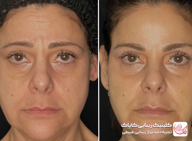 تزریق بوتاکس پیشانی برای درمان میگرن