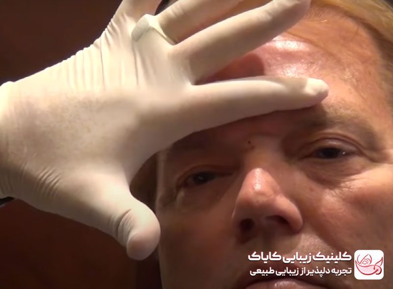 تزریق بوتاکس پیشانی