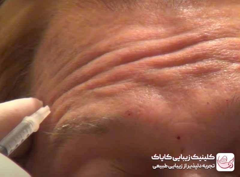 تزریق بوتاکس پیشانی