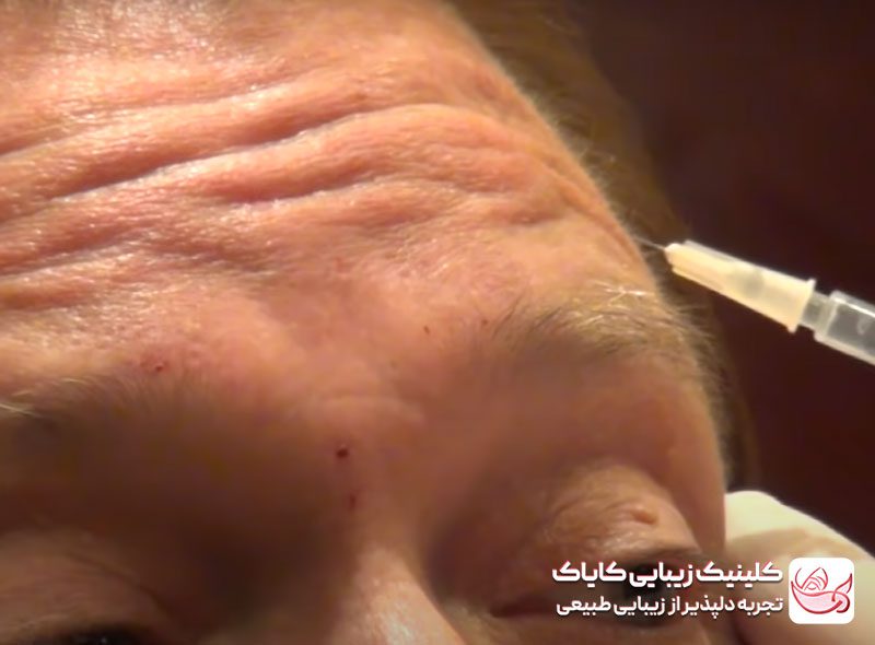 تزریق بوتاکس پیشانی