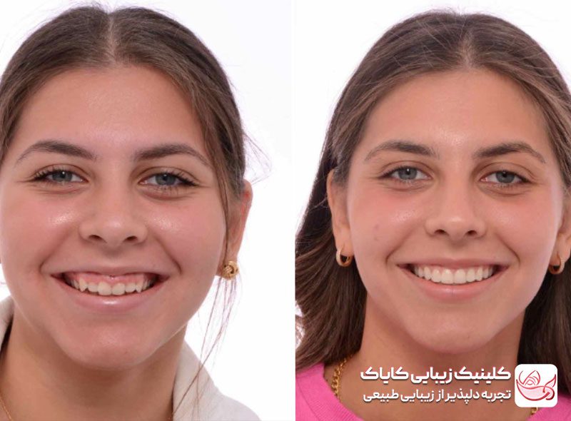 بوتاکس لبخند لثه‌ای قبل و بعد