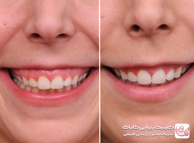 بوتاکس لبخند لثه ای قبل و بعد
