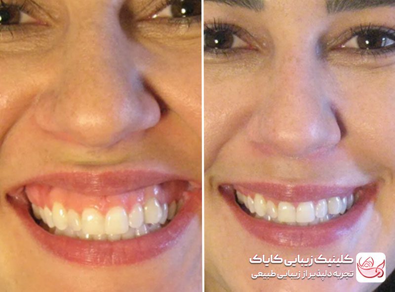 بوتاکس لبخند لثه ای قبل و بعد