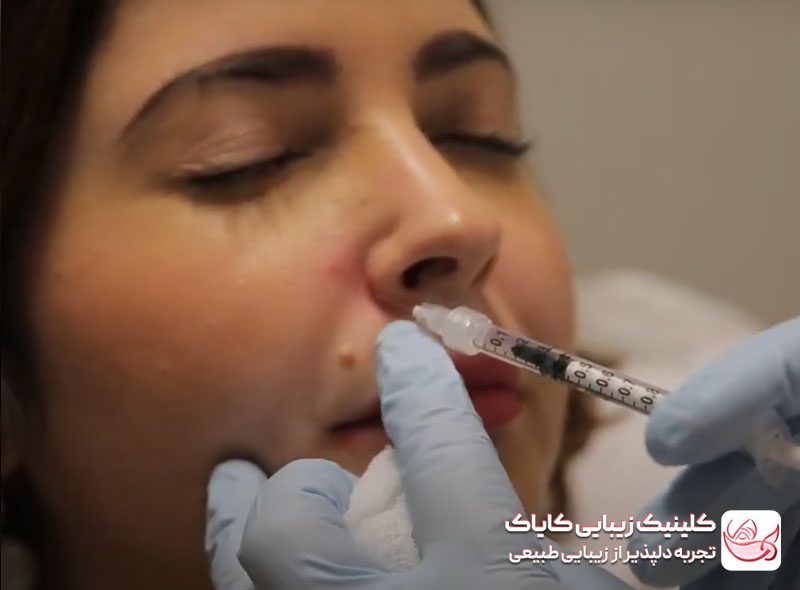 فرآیند تزریق بوتاکس لبخند