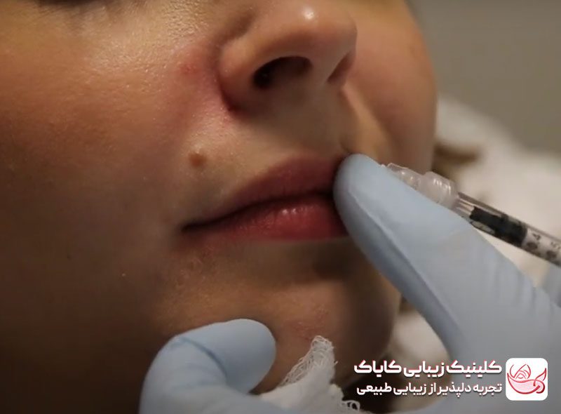 فرآیند تزریق بوتاکس لبخند