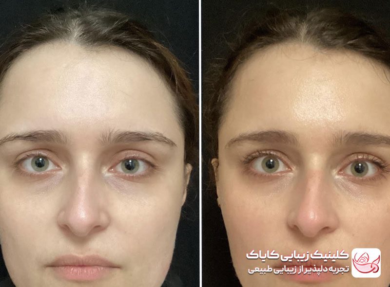 بوتاکس میگرن برای درمان دردهای میگرنی - قبل و بعد