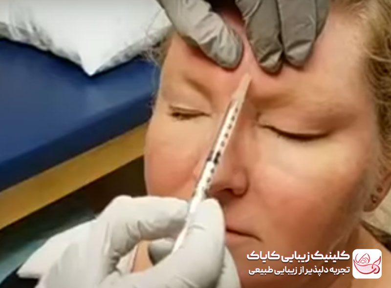 فرآیند تزریق بوتاکس برای درمان میگرن