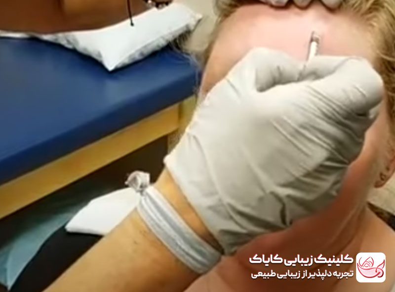 فرآیند تزریق بوتاکس برای درمان میگرن