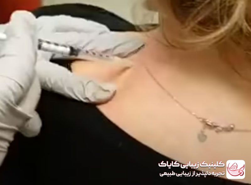 فرآیند تزریق بوتاکس برای درمان میگرن