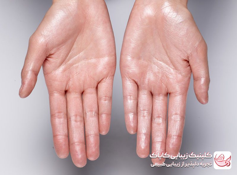 بوتاکس کف دست و پا