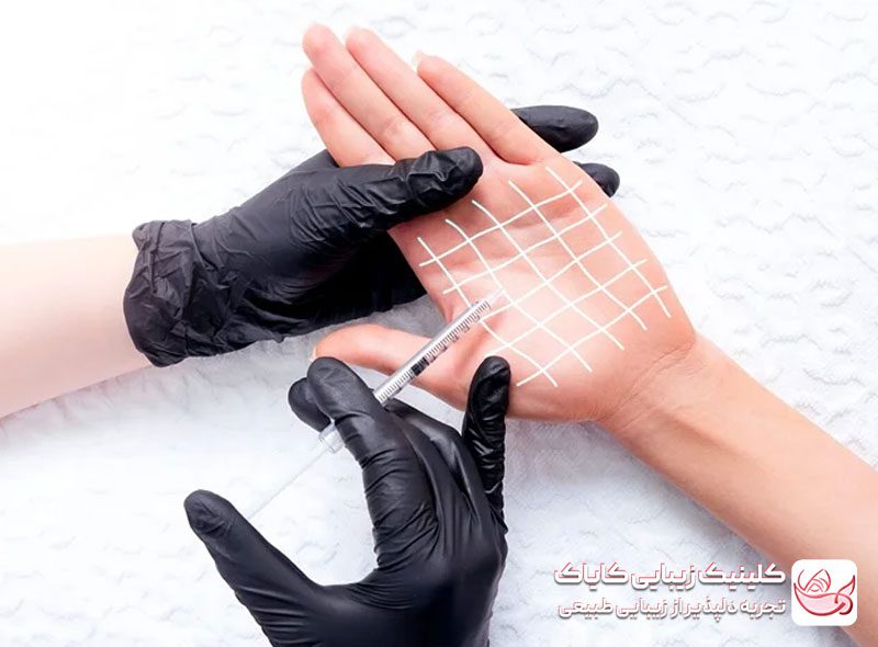 بوتاکس تعریق کف‌دست و پا