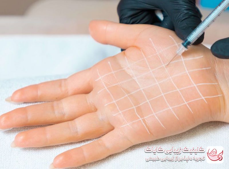 بوتاکس تعریق کف‌دست و پا