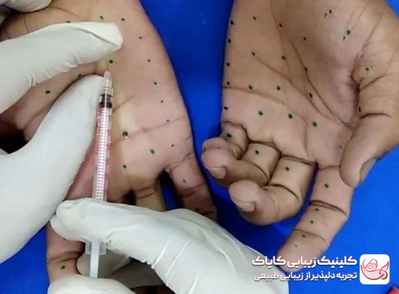 بوتاکس تعریق کف‌دست و پا