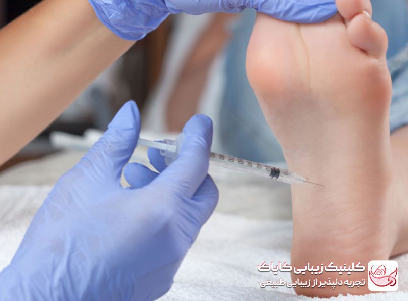 بوتاکس کف دست و پا