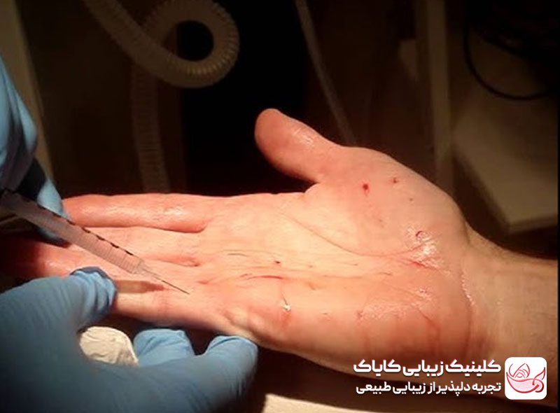 بوتاکس تعریق کف‌دست و پا