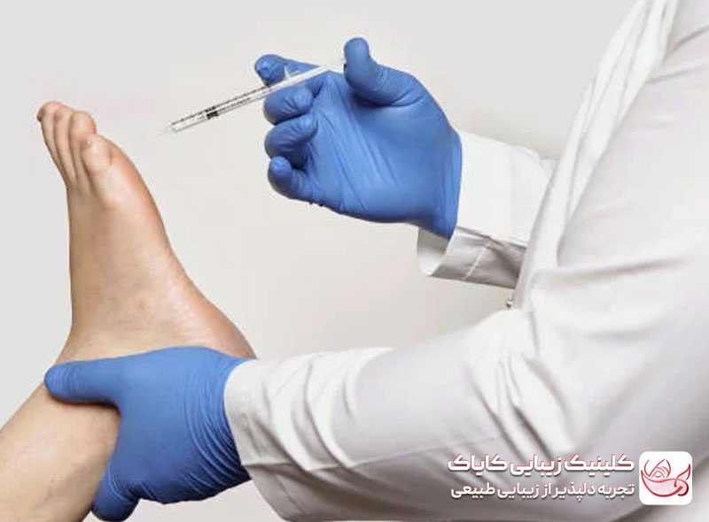 بوتاکس تعریق کف‌دست و پا