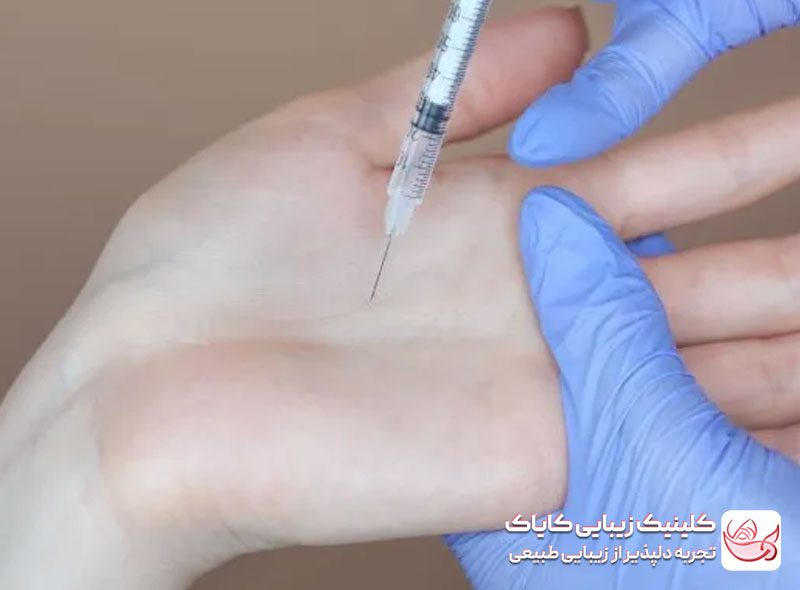 بوتاکس تعریق کف‌دست و پا