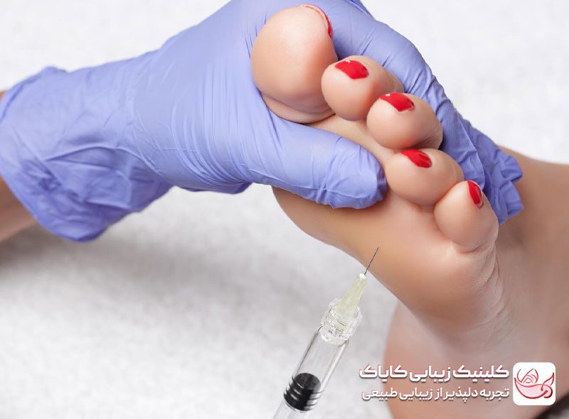 بوتاکس تعریق کف‌دست و پا