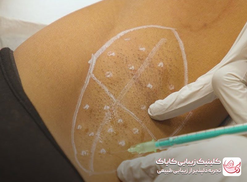 تزریق بوتاکس زیربغل