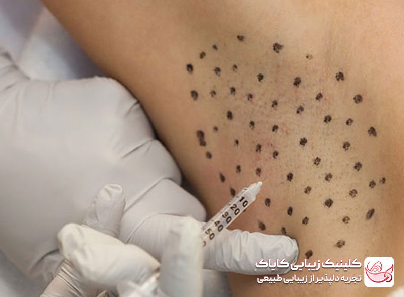تزریق بوتاکس زیر بغل