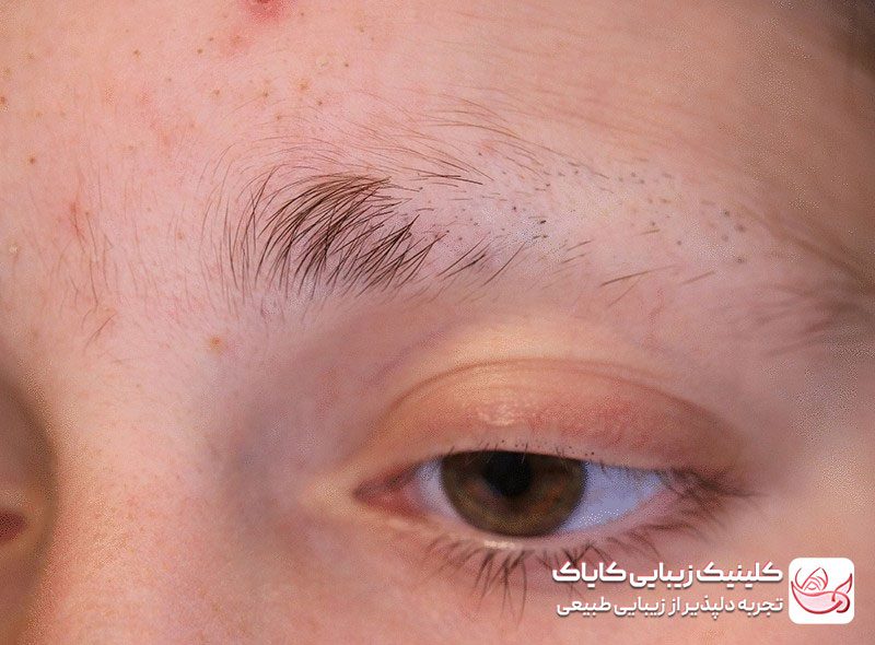 ترمیم ابرو پس از جراحات و سوختگی‌ها