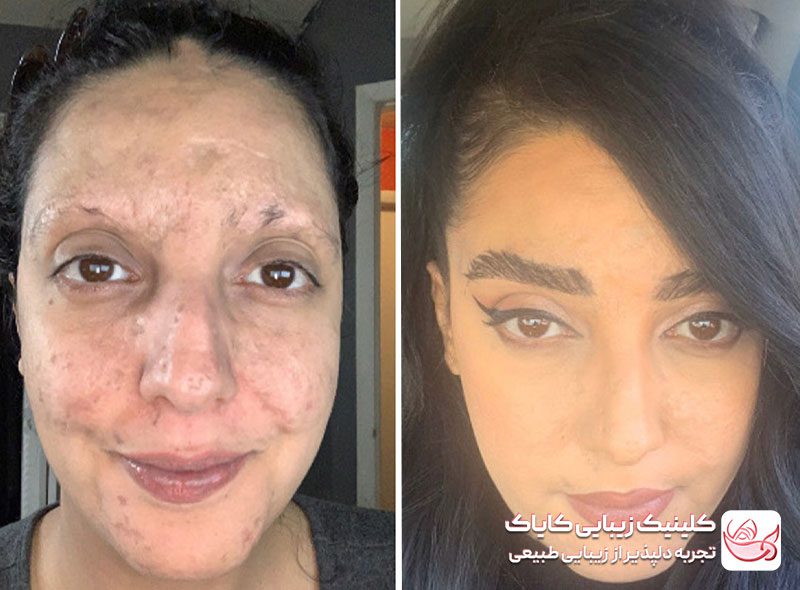 کاشت ابرو قبل و بعد