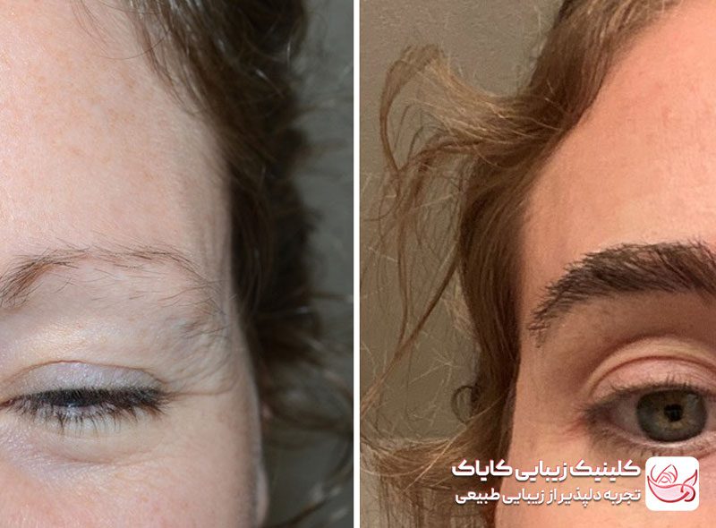 کاشت ابرو قبل و بعد