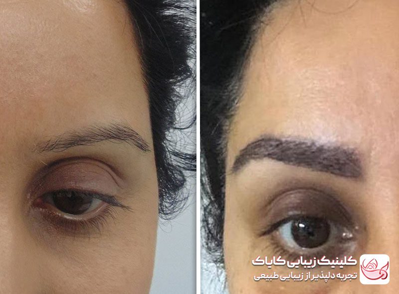 کاشت ابرو قبل و بعد