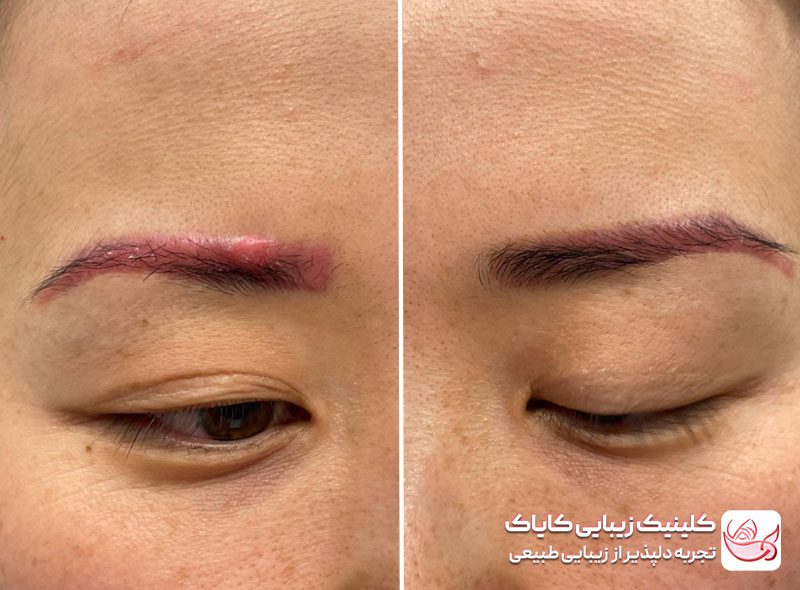 کاشت ابرو در پاسداران