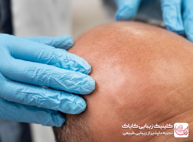درمان ریزش مو و طاسی ارثی