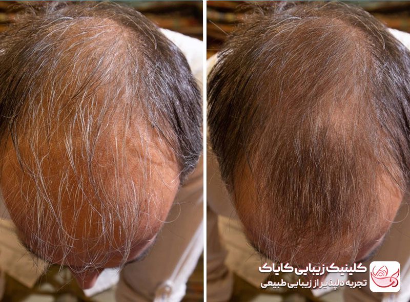 کربوکسی تراپی مو قبل و بعد