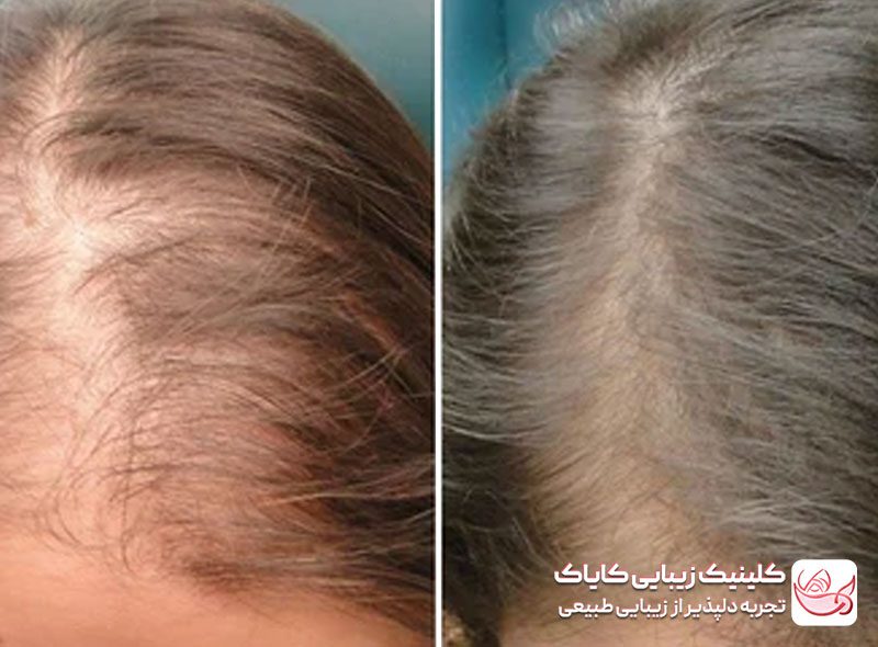 کربوکسی تراپی مو قبل و بعد