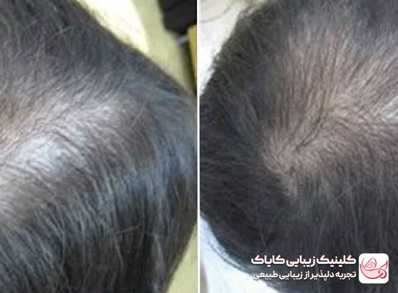 کربوکسی تراپی مو قبل و بعد
