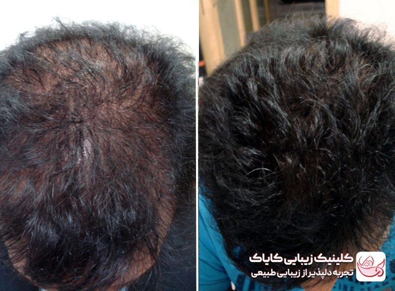 کربوکسی تراپی مو قبل و بعد