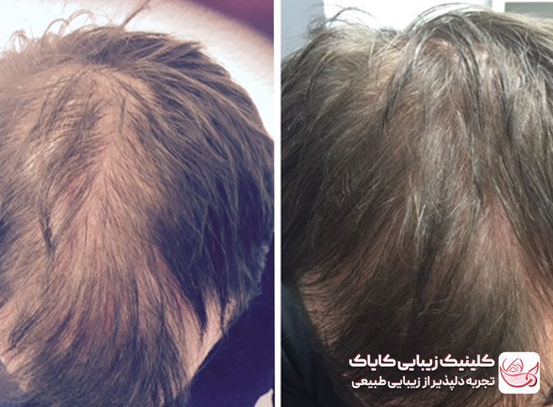 کربوکسی تراپی مو قبل و بعد