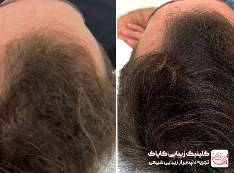 هیر فیلر قبل و بعد