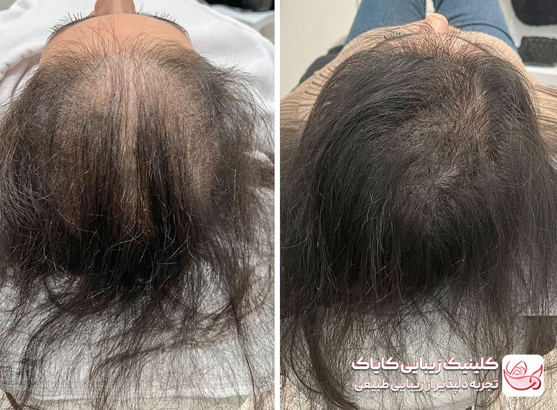 درمان ریزش مو قبل و بعد