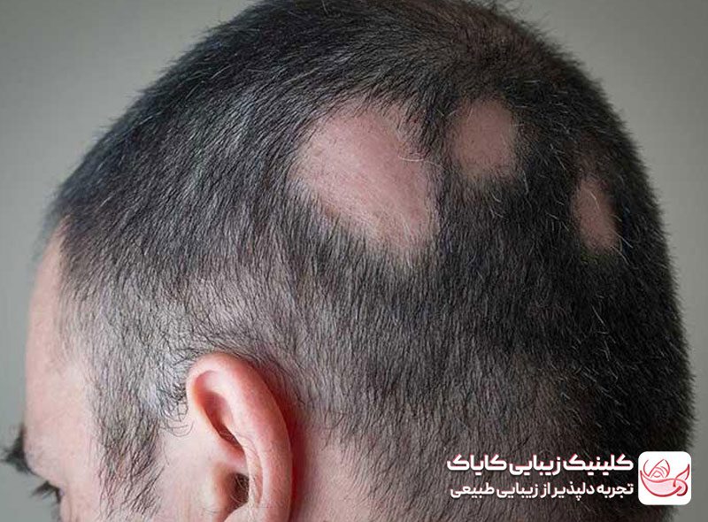 درمان ریزش مو ناشی از بیماری‌های خاص