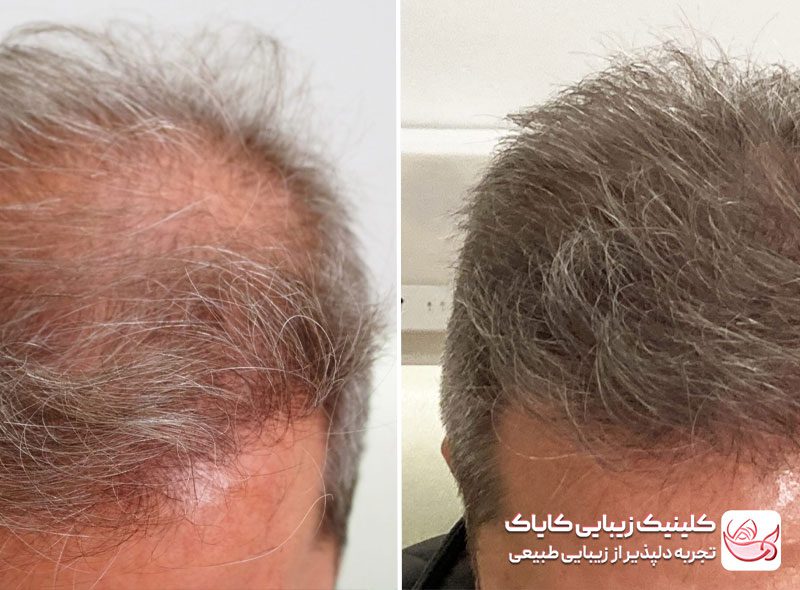 مزوتراپی مو قبل و بعد
