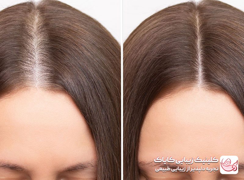 مزوتراپی مو قبل و بعد