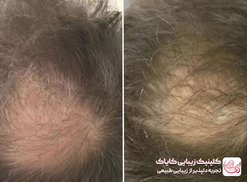 مزوتراپی مو قبل و بعد