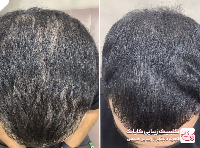 مزوتراپی مو قبل و بعد