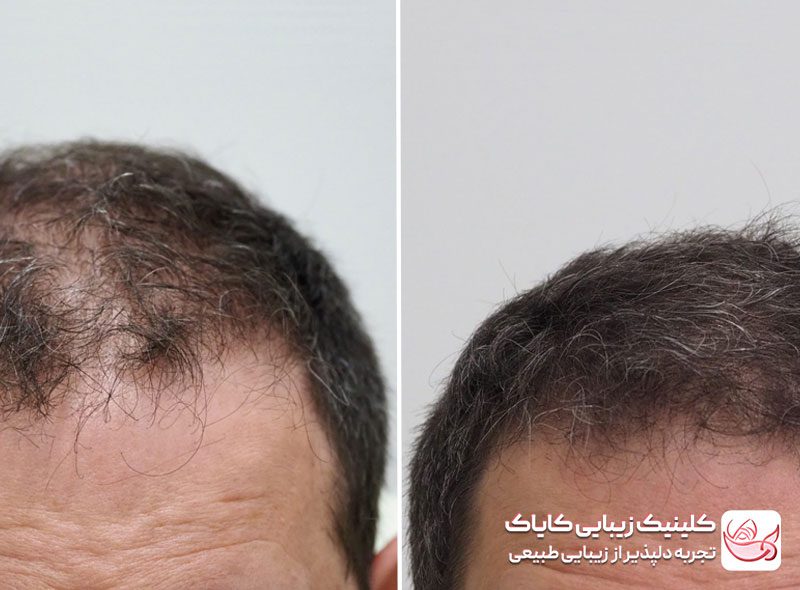 مزوتراپی مو قبل و بعد