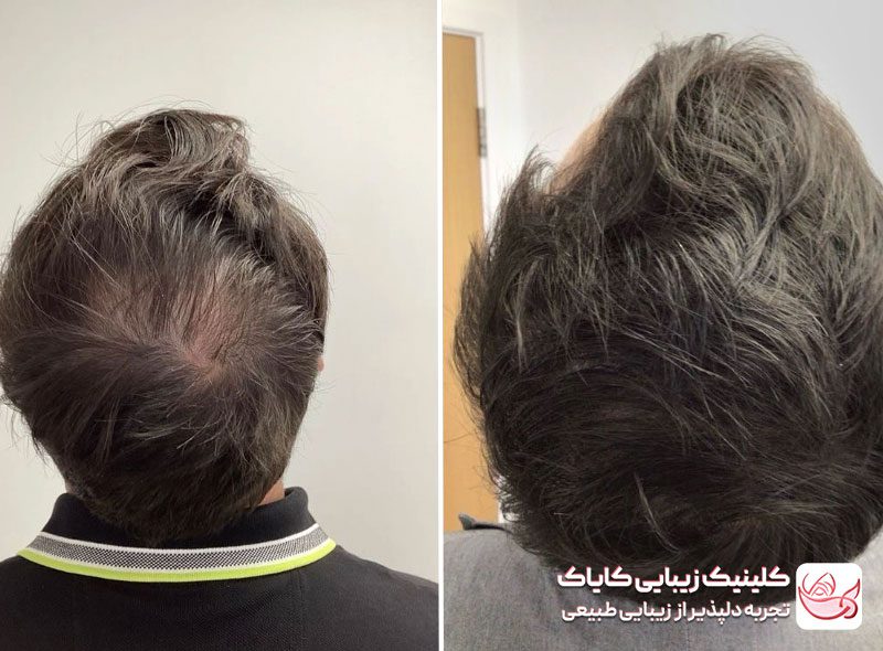 پی آر پی مو قبل و بعد