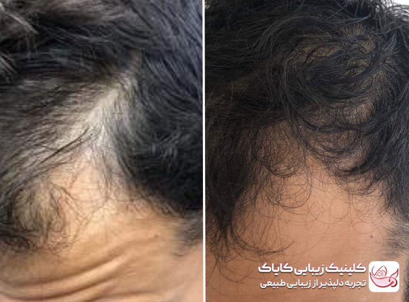 پی آر پی مو قبل و بعد