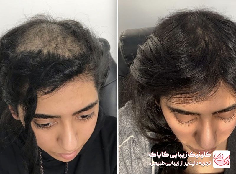 پی آر پی مو قبل و بعد